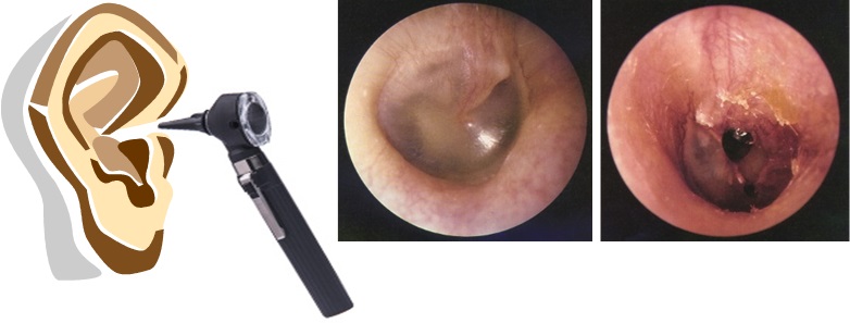 オトスコープ‐お耳の内部‐鼓膜画像
